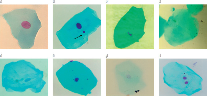 Assessment of buccal mucosa genotoxicity in insecticide-exposed urban fumigators in Cali, Colombia.
