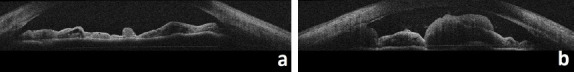 Bilateral Iris Metastasis in a Patient with Small Cell Lung Carcinoma: A Case Report.