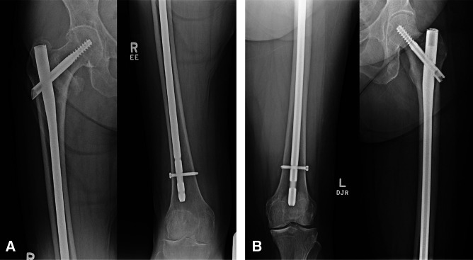 Outcomes of Name-brand Versus Generic Cephalomedullary Nail Fixation for Intertrochanteric and Subtrochanteric Fractures: A Matched Cohort Study.