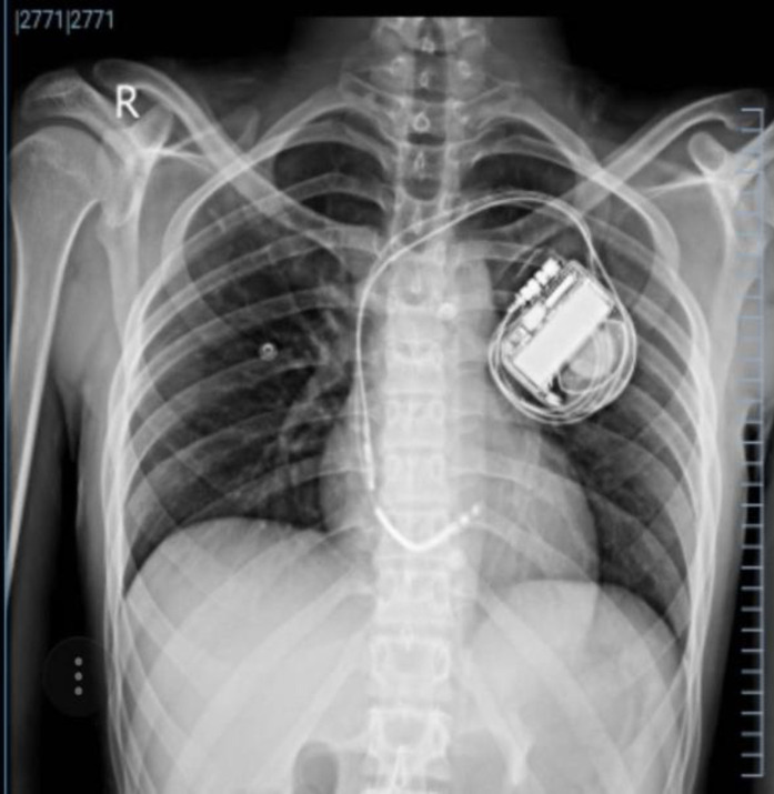 The association between GJB2 gene (producing Cx26 protein) and the ventricular storm: A case report.