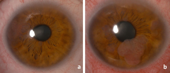 Bilateral Iris Metastasis in a Patient with Small Cell Lung Carcinoma: A Case Report.