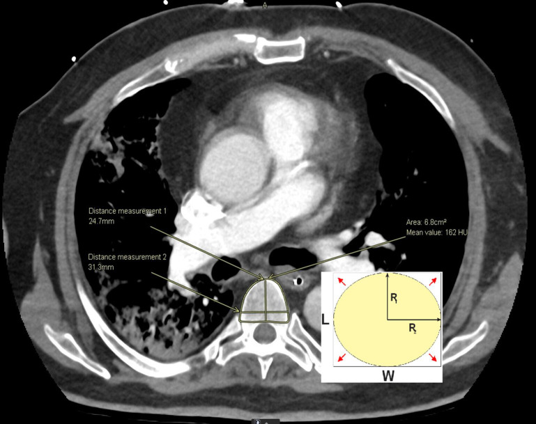 The identification of an optimal body size parameter to adjust skeletal muscle area on chest CT in COVID-19 patients.