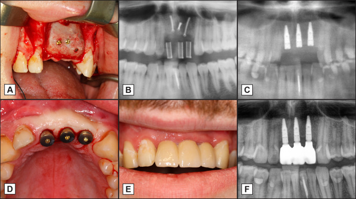 Dental Implant Placement in the Maxilla Following Ridge Augmentation with Free Iliac Bone Graft and Oral Rehabilitation with Fixed Prosthesis: a Three-Year Follow-Up Study.
