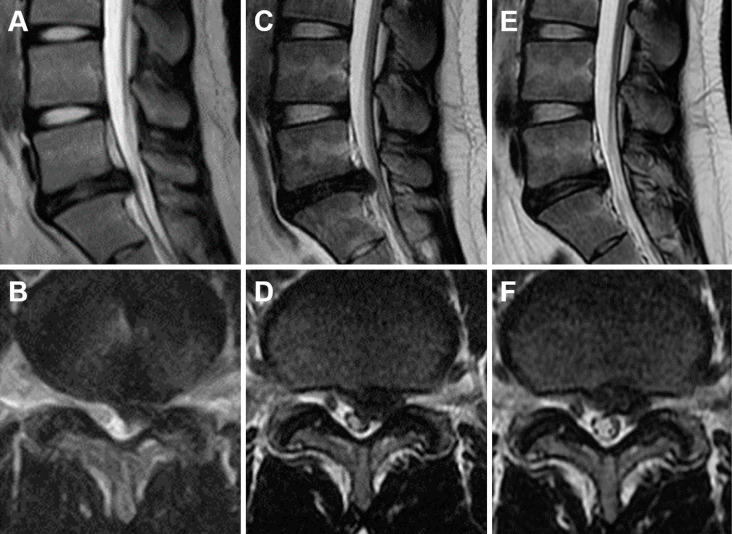 Efficacy of Chemonucleolysis with Condoliase in Patients Aged under 20 Years.
