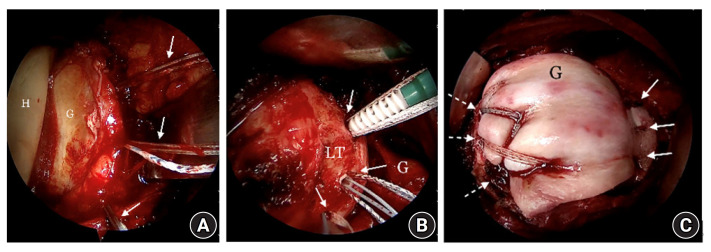 Anterior capsular reconstruction with acellular dermal allograft for subscapularis deficiency: a report of two cases.