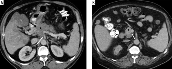 Qualitative and quantitative imaging features of solid pancreas tumours in portal venous phase CT: are they useful in determining tumour type and grade?
