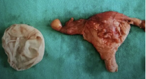 Primary Solitary Uterine Hydatid Cyst Mimicking an Intramyometrial Cyst: A Case Report.
