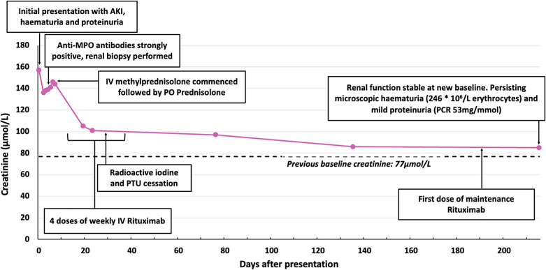 Propylthiouracil-Induced Antineutrophil Cytoplasmic Antibody-Associated Vasculitis with Overlap IgA Nephropathy: A Case Report.