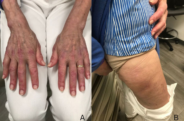 Amyopathic dermatomyositis may be on the spectrum of autoinflammatory disease: A clinical review.
