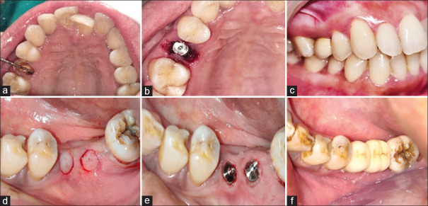 Assessment of peri-implant tissues in posterior implants placed using flapless approach: A clinicoradiographic study.
