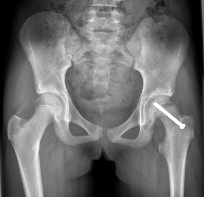 The clinical value of preoperative 3D planning and 3D surgical guides for Imhäuser osteotomy in slipped capital femoral epipysis: a retrospective study.