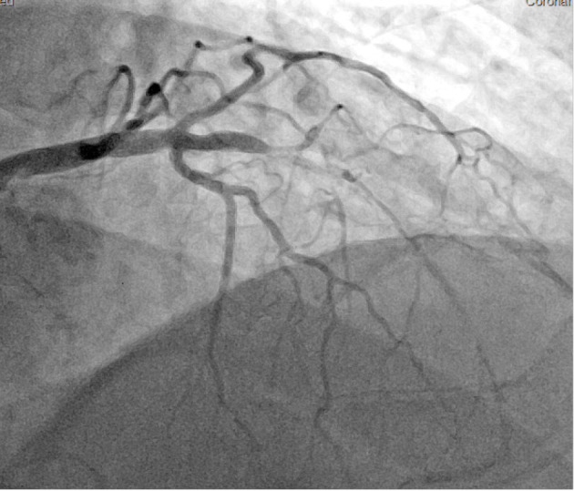 INTRAVASCULAR LITHOTRIPSY FOR SEVERE STENT UNDEREXPANSION.