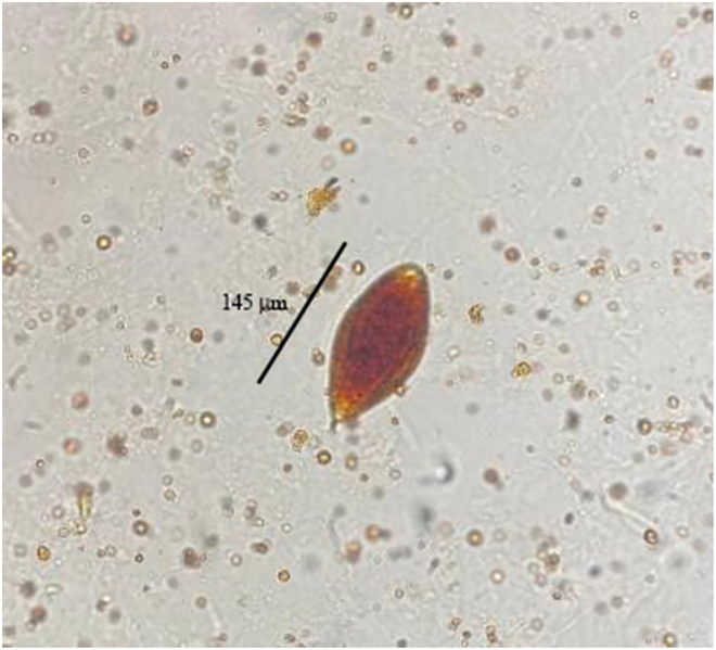 Insights into the epidemiology, pathogenesis, and differential diagnosis of schistosomiasis.