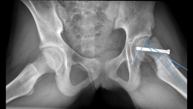 The clinical value of preoperative 3D planning and 3D surgical guides for Imhäuser osteotomy in slipped capital femoral epipysis: a retrospective study.
