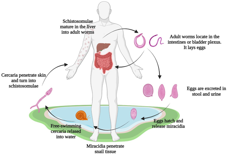 Insights into the epidemiology, pathogenesis, and differential diagnosis of schistosomiasis.