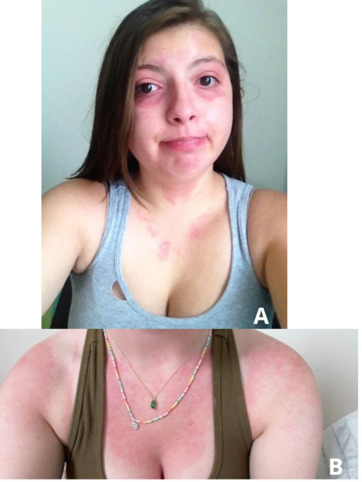 Amyopathic dermatomyositis may be on the spectrum of autoinflammatory disease: A clinical review.