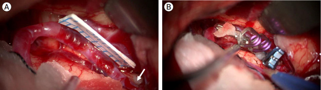 Microsurgical treatment of distal middle cerebral artery aneurysm: A single-center review.