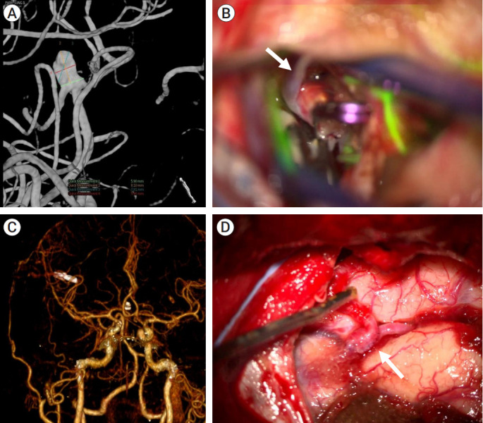 Microsurgical treatment of distal middle cerebral artery aneurysm: A single-center review.