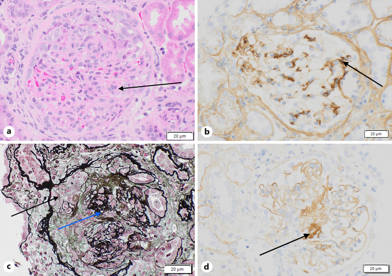 Propylthiouracil-Induced Antineutrophil Cytoplasmic Antibody-Associated Vasculitis with Overlap IgA Nephropathy: A Case Report.