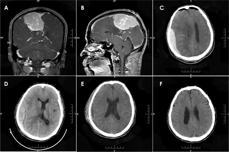 Postoperative epidural hematoma as a rare complication after intracranial tumor resection: a case series report and causes analysis.