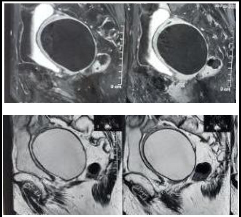 Primary Solitary Uterine Hydatid Cyst Mimicking an Intramyometrial Cyst: A Case Report.