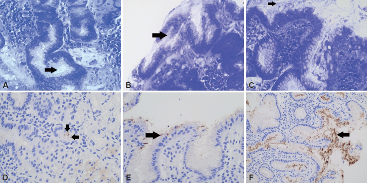 Role of <i>Helicobacter pylori</i> Immunohistochemistry in the Histopathological Assessment of Inflamed Endoscopic Gastric Biopsies.