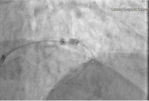 INTRAVASCULAR LITHOTRIPSY FOR SEVERE STENT UNDEREXPANSION.
