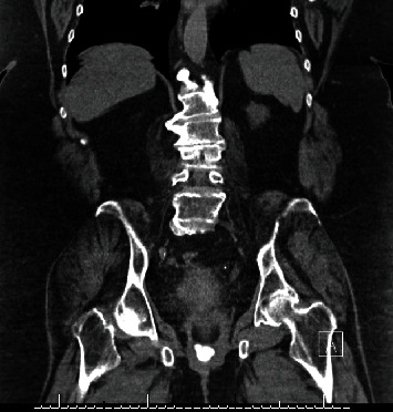 Vaginal Calculus Formation on Exposed Midurethral Sling Mesh.