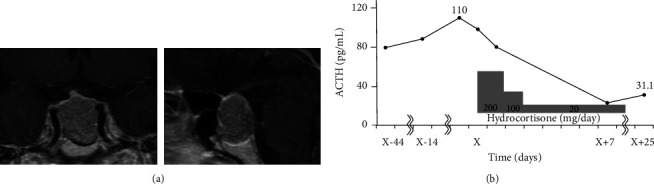 Subclinical Cushing's Disease with High-Molecular-Weight Forms of Adrenocorticotropic Hormone Production.