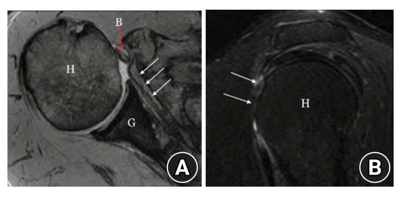 Anterior capsular reconstruction with acellular dermal allograft for subscapularis deficiency: a report of two cases.