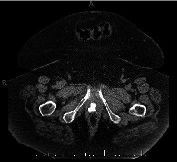Vaginal Calculus Formation on Exposed Midurethral Sling Mesh.