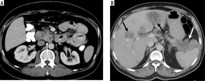 Qualitative and quantitative imaging features of solid pancreas tumours in portal venous phase CT: are they useful in determining tumour type and grade?