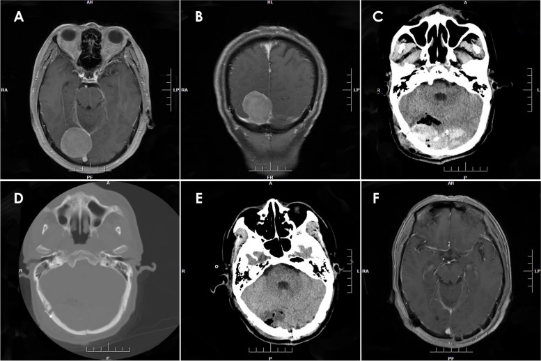 Postoperative epidural hematoma as a rare complication after intracranial tumor resection: a case series report and causes analysis.