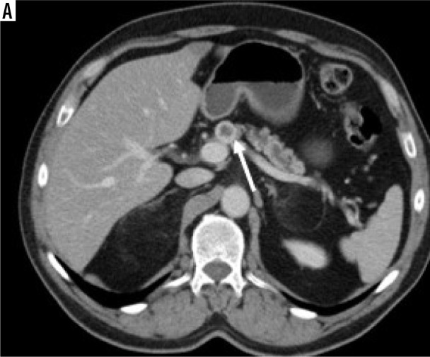 Qualitative and quantitative imaging features of solid pancreas tumours in portal venous phase CT: are they useful in determining tumour type and grade?