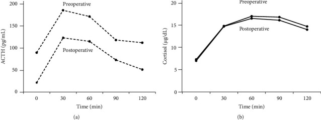 Subclinical Cushing's Disease with High-Molecular-Weight Forms of Adrenocorticotropic Hormone Production.