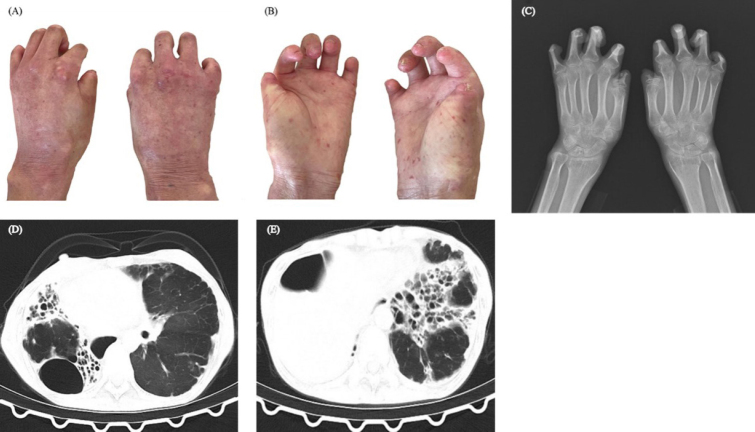 The vanishing touch: Unveiling the tuft erosion in scleroderma.