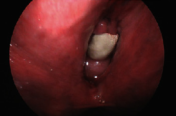 Vaginal Calculus Formation on Exposed Midurethral Sling Mesh.