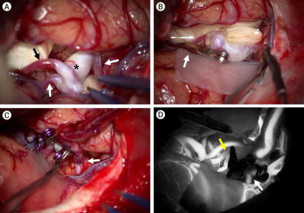Microsurgical treatment of distal middle cerebral artery aneurysm: A single-center review.