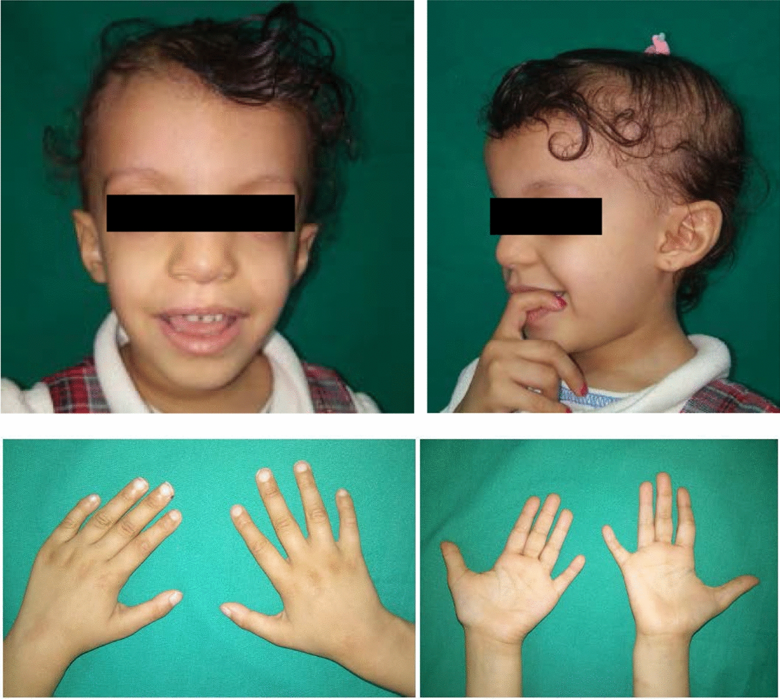 11p13 microduplication: a differential diagnosis of Silver-Russell syndrome?