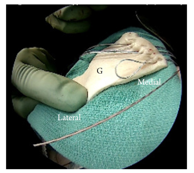 Anterior capsular reconstruction with acellular dermal allograft for subscapularis deficiency: a report of two cases.