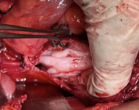 Primary Solitary Uterine Hydatid Cyst Mimicking an Intramyometrial Cyst: A Case Report.