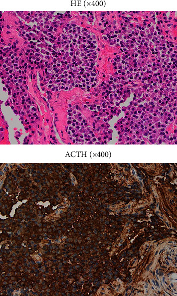 Subclinical Cushing's Disease with High-Molecular-Weight Forms of Adrenocorticotropic Hormone Production.