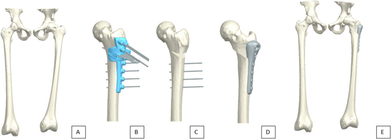 The clinical value of preoperative 3D planning and 3D surgical guides for Imhäuser osteotomy in slipped capital femoral epipysis: a retrospective study.