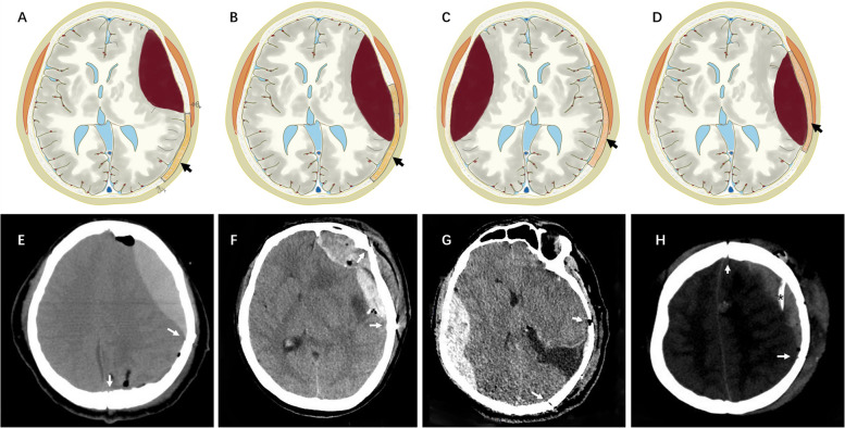 Postoperative epidural hematoma as a rare complication after intracranial tumor resection: a case series report and causes analysis.