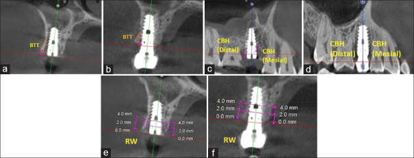 Assessment of peri-implant tissues in posterior implants placed using flapless approach: A clinicoradiographic study.