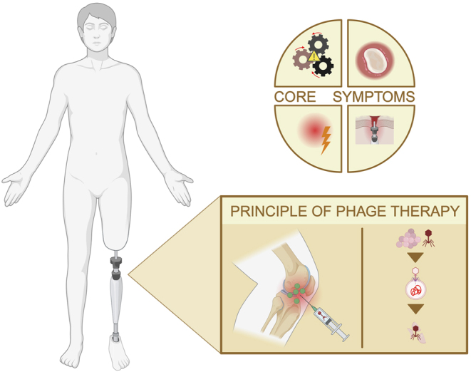 Phage therapy in prosthetic joint infections caused by Staphylococcus aureus - A literature review.