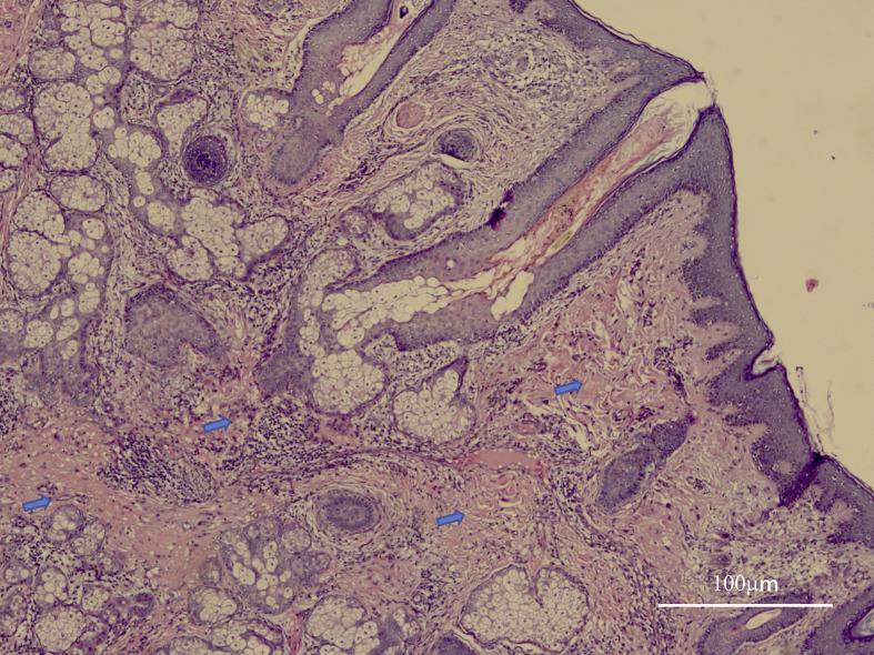 Comprehensive Treatment of a Rare Case of Complete Primary Pachydermoperiostosis with Large Facial Keloid Scars: A Case Report and Literature Review.