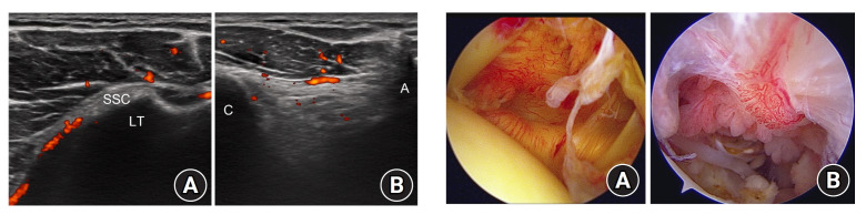 Blood flow velocity in the anterior humeral circumflex artery and tear size can predict synovitis severity in patients with rotator cuff tears.
