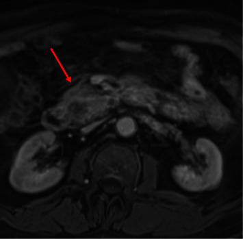 Pancreatic Myeloid Sarcoma Causing Obstructive Jaundice: A Case Report and Literature Review.