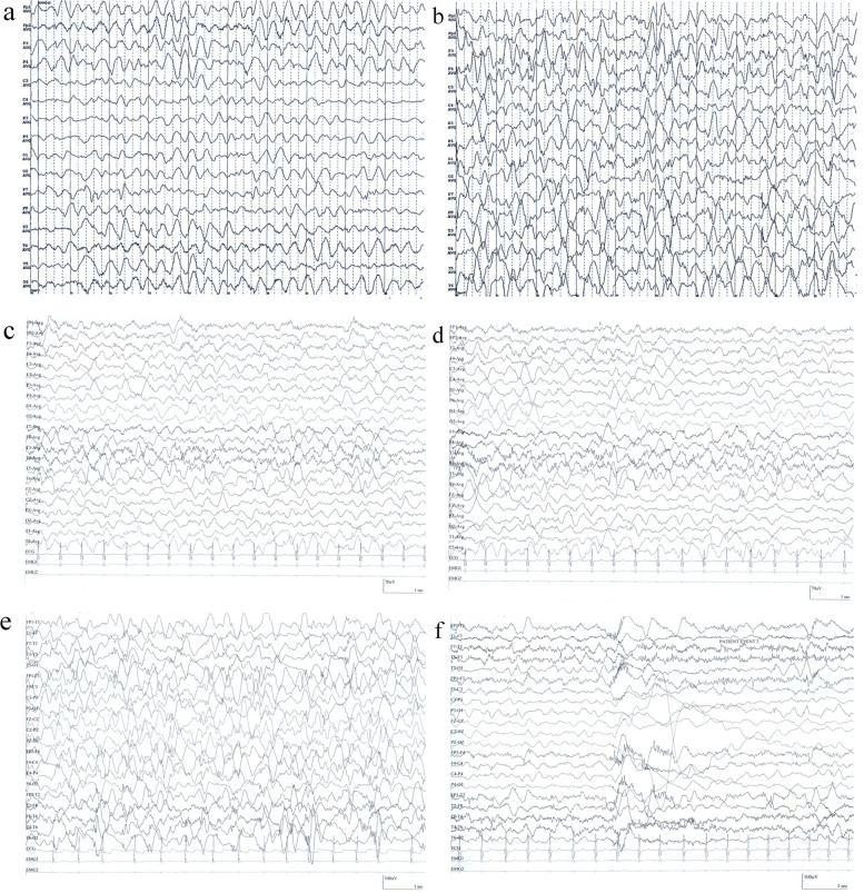 Genetic variant reanalysis reveals a case of Sandhoff disease with onset of infantile epileptic spasm syndrome.